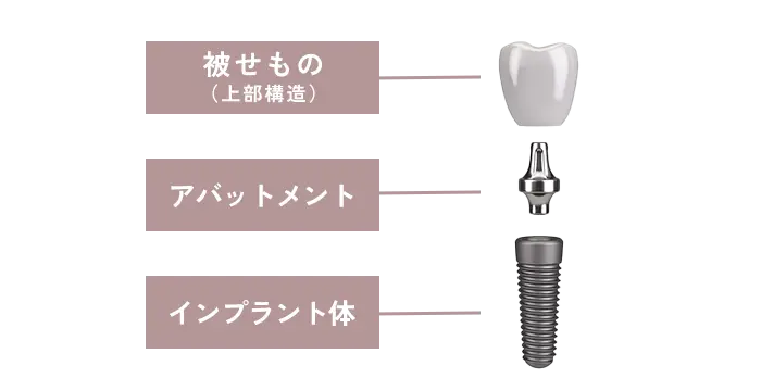 デンタルローン